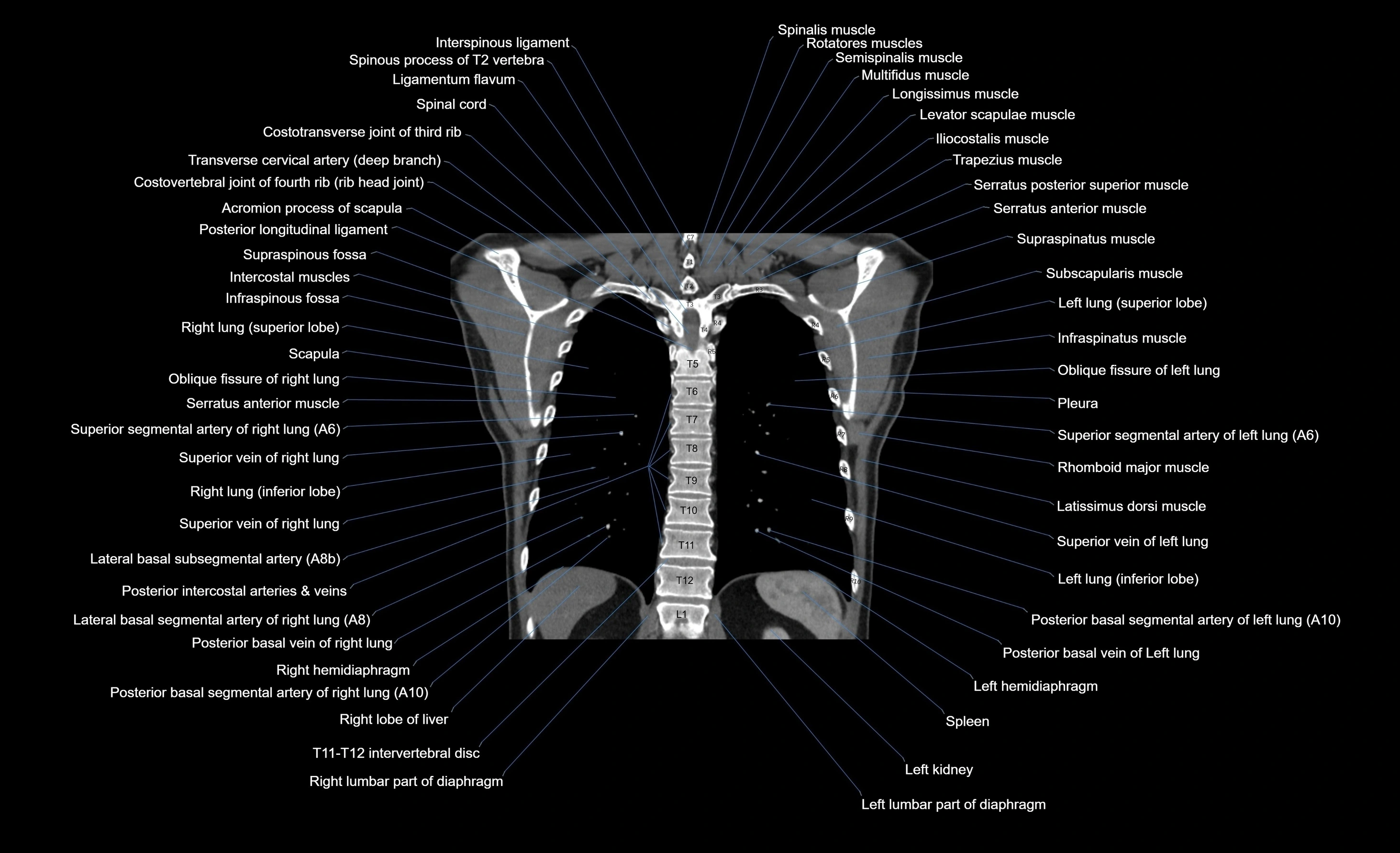 CT chest (thorax) labelled coronal cross sectional anatomy radiology image-00033.webp